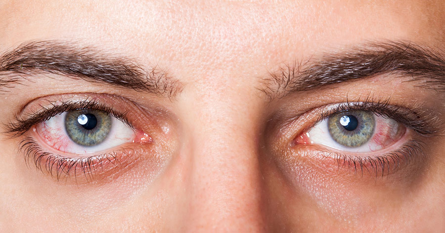 Navigating Eye Allergies: Causes, Symptoms, and Prevention Strategies
